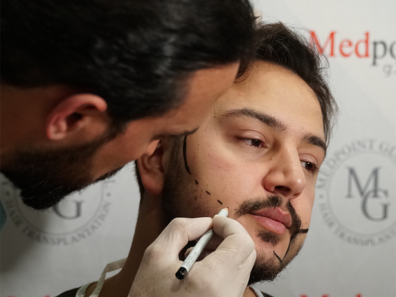 Trapianto Di Barba