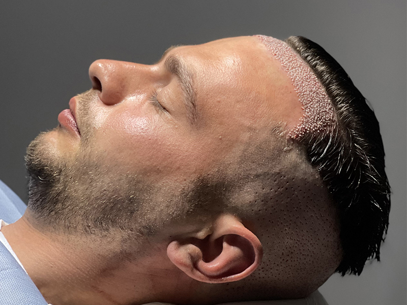 Tıraşsız Saç Ekimi