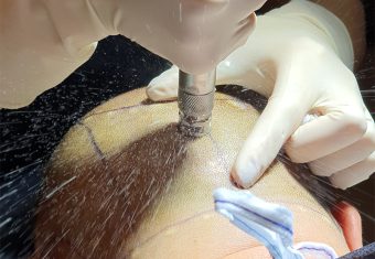 Painless Anesthesia