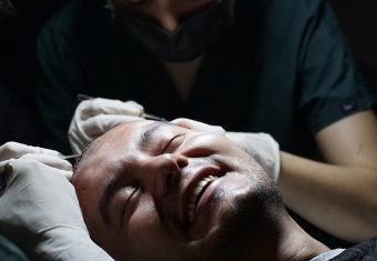 What is Hair Transplant ?